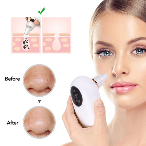 Portable Vacuum Blackhead Remover Before and After - Visibly Cleaner Pores with Deep Suction Technology
